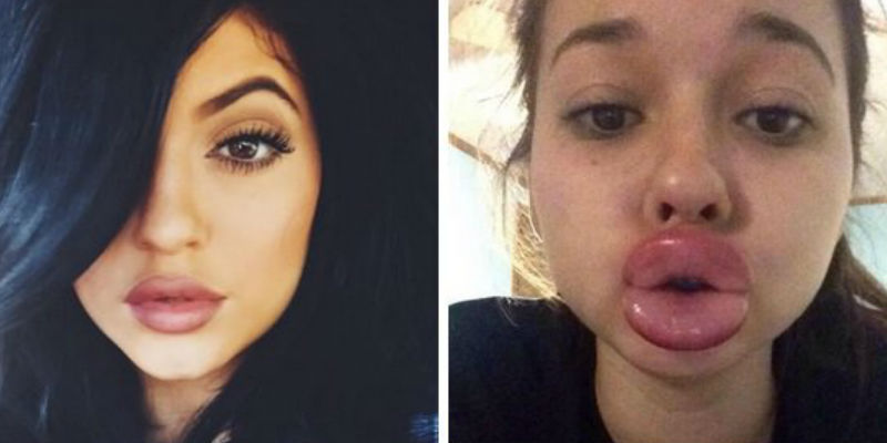 lips-challenger-kylie-jenner